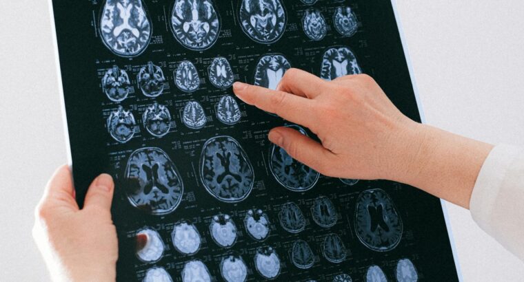 NEUROLOGIA (clinica de la migraña)